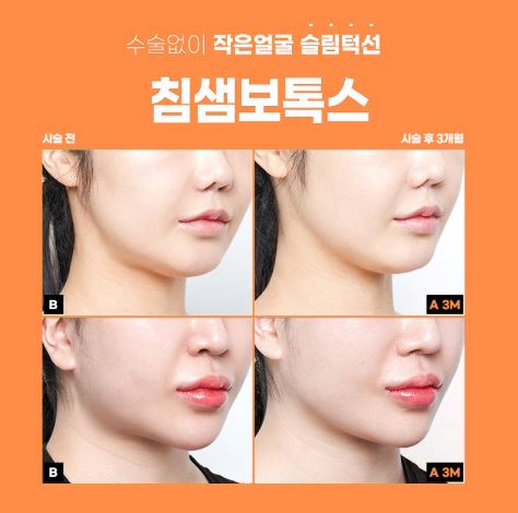 사각턱 보톡스
