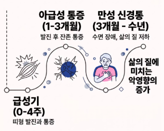 대상포진 초기증상