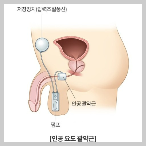 남성 요실금 원인, 여러가지 약물치료, 수술, 놀라운 효과.
