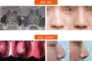 비염코막힘