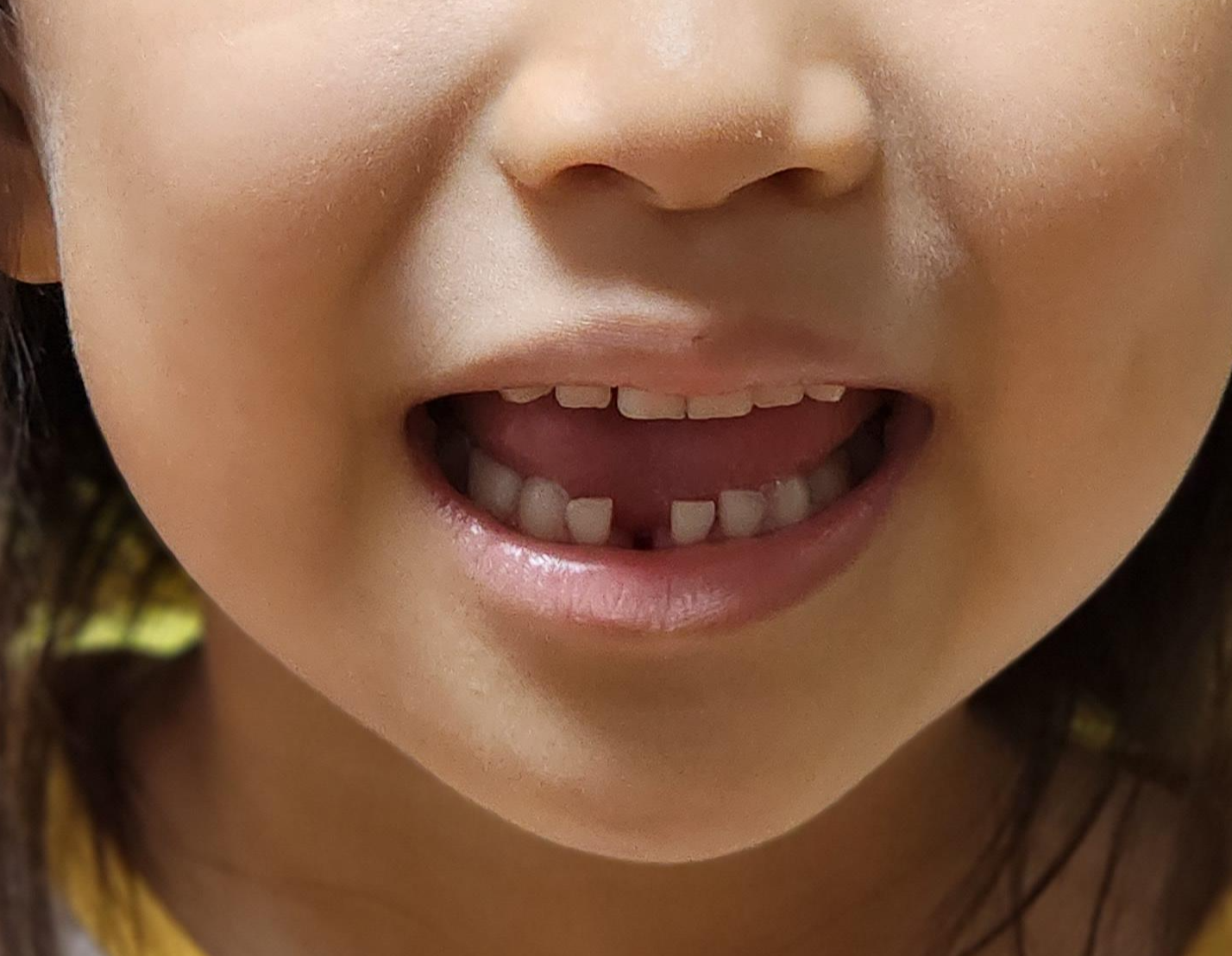 안아프게이빨뽑기