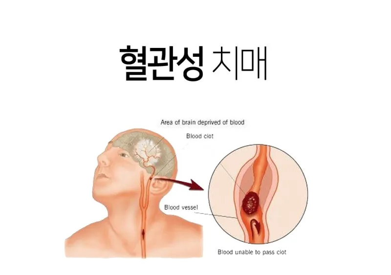 혈관성치매 원인 증상 치료법과 예방 생활습관_4