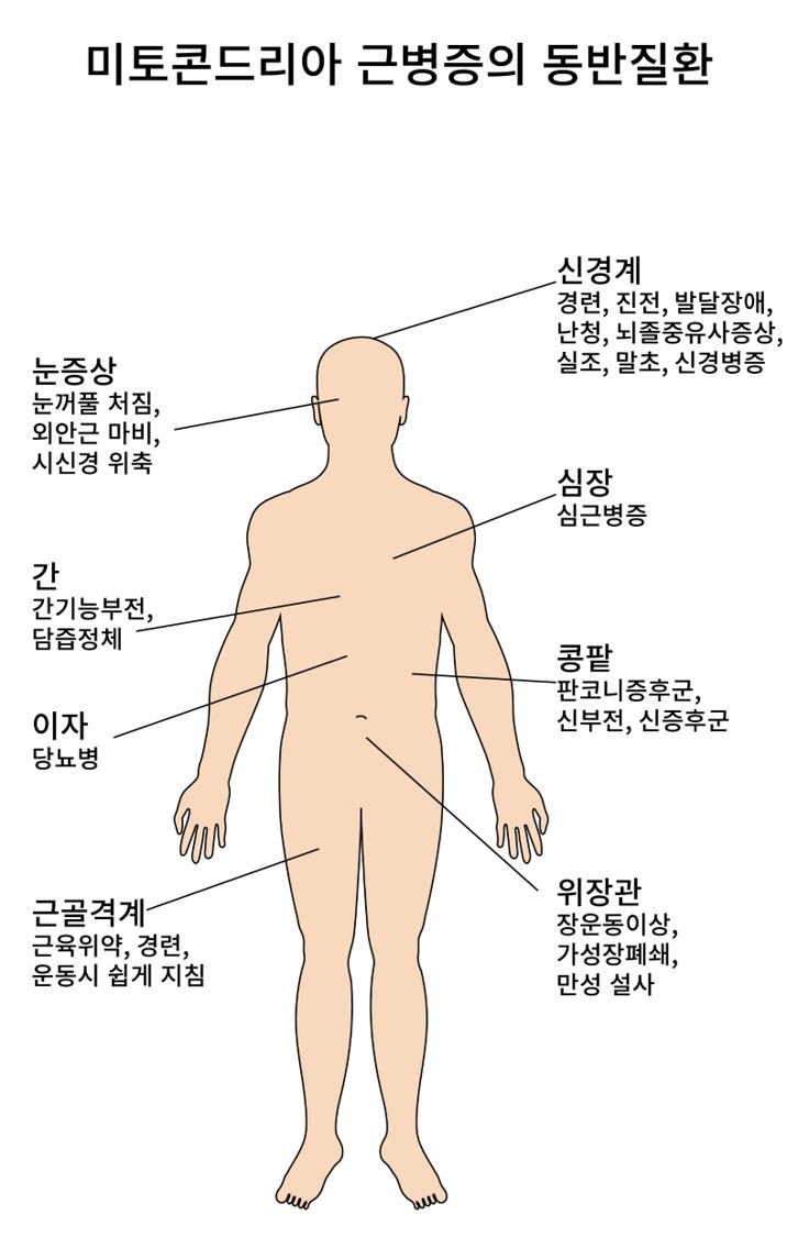 미토콘드리아 근병증 NEC