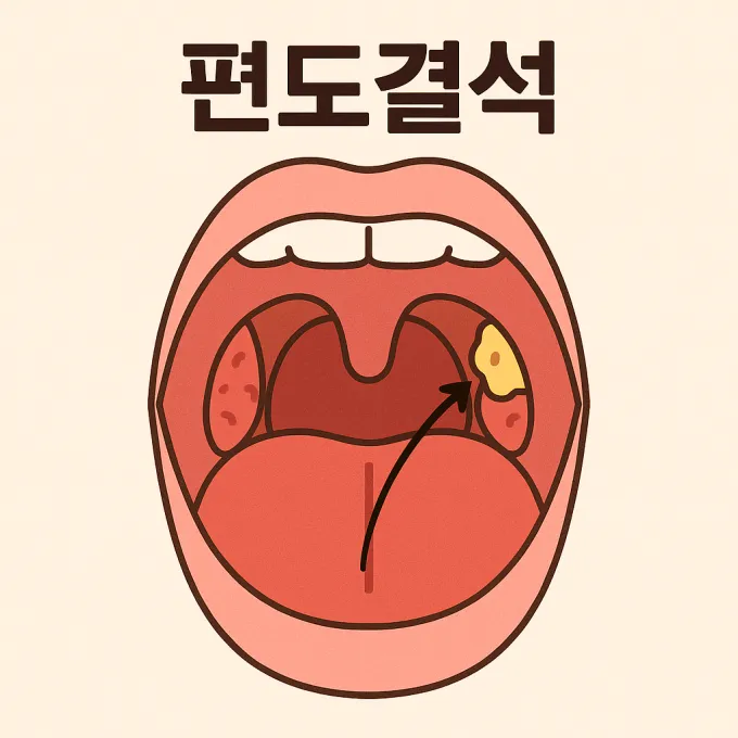 편도결석 빼는법