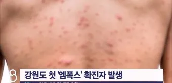 엠폭스 증상 예방접종 대처법 치료방법_19