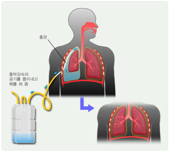 기흉수술