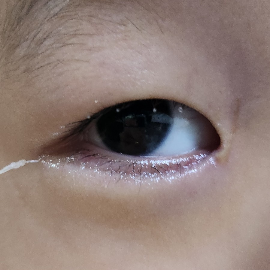 수술 4일 후 눈