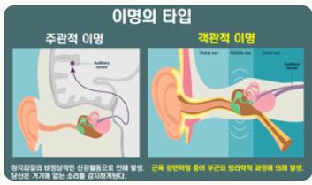 이명 증상 원인 치료방법