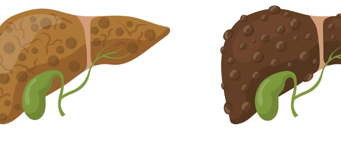 지방간 질환이 치료되지 않으면 어떻게 될까요?