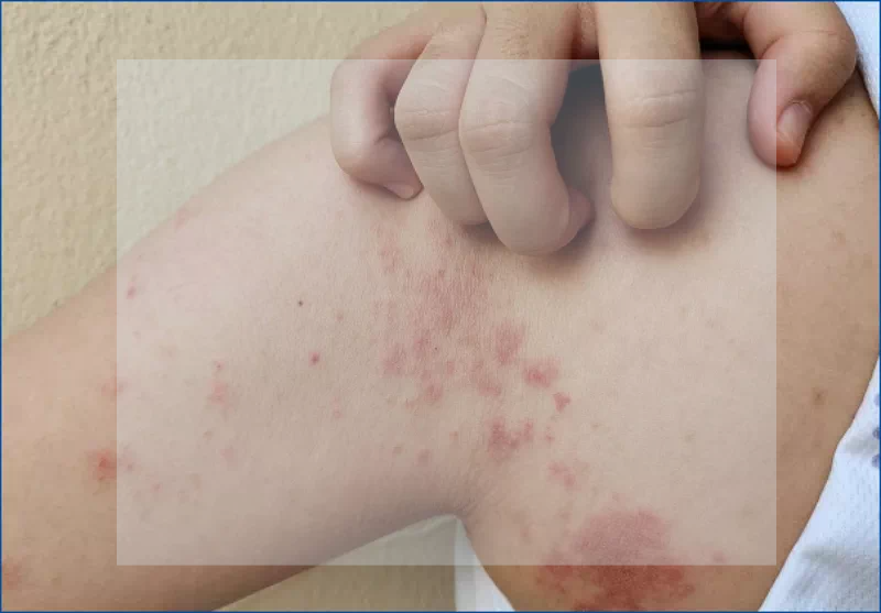 피부 두드러기