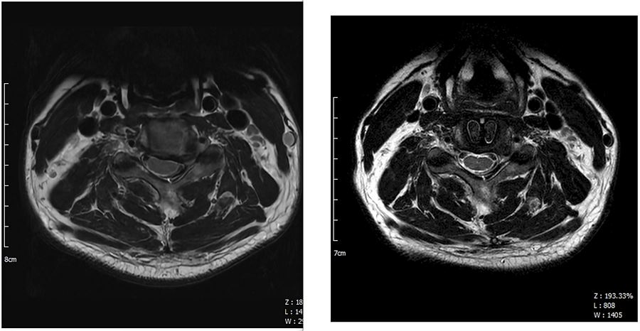 경추 MRI 가로 사진. C4-C5 수술전(좌) 수술후(우)