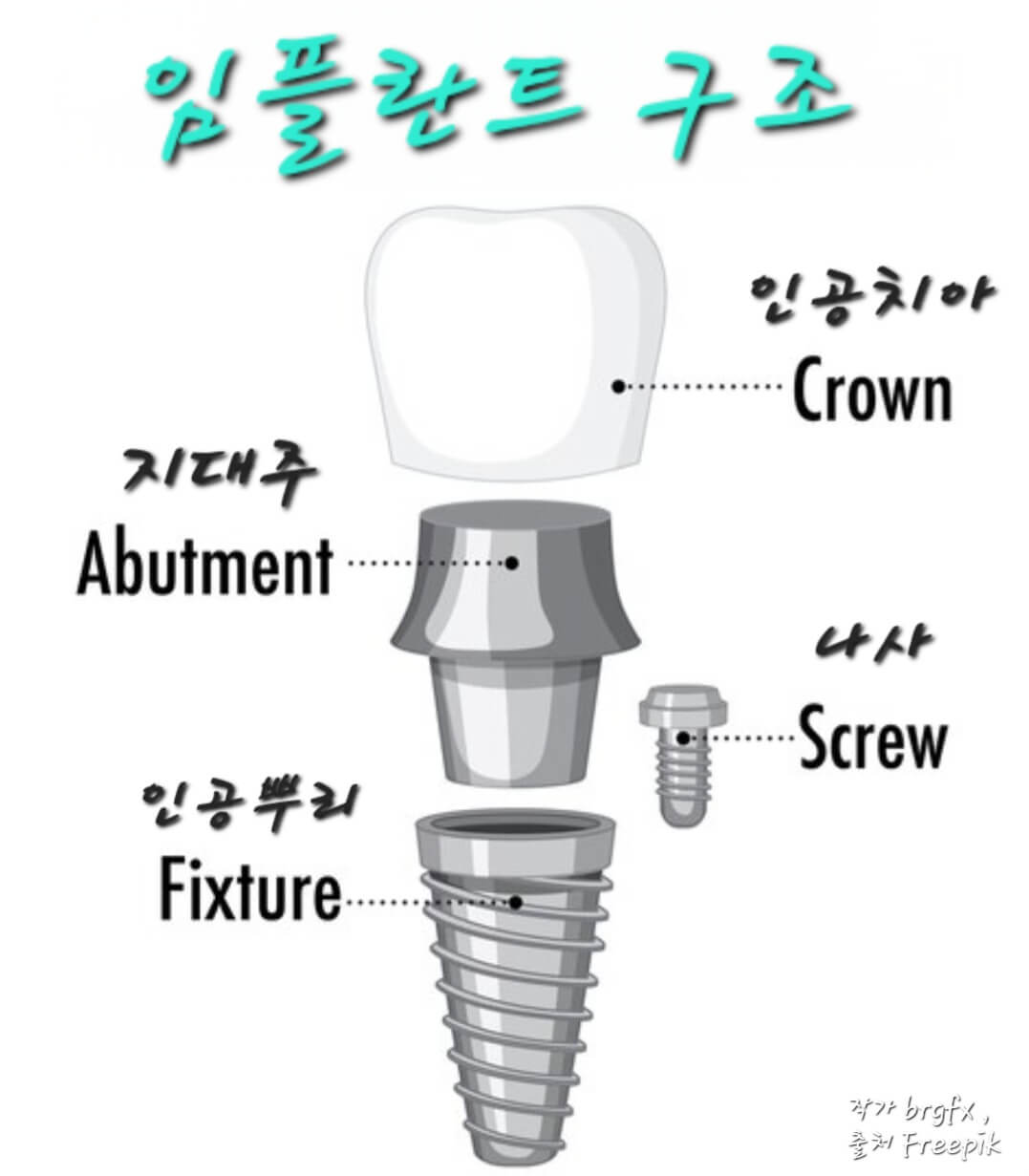 임플란트 구조 설명하는 사진