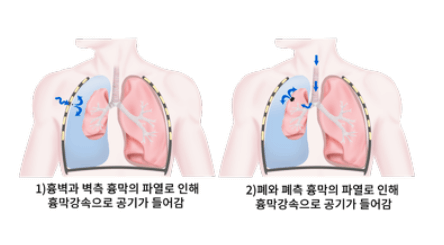 폐기흉
폐기흉 뜻
폐기흉 증상