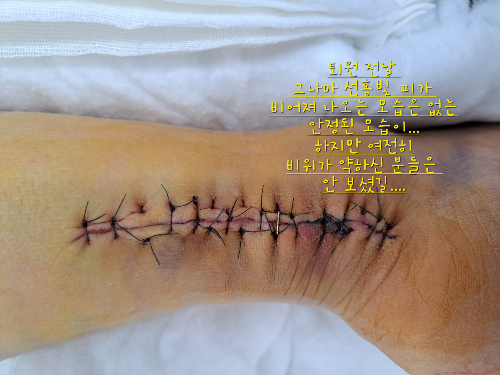 아킬레스건 완전 파열 후기-처음엔 걸어서 동네 정형외과를 찾아갔습니다.