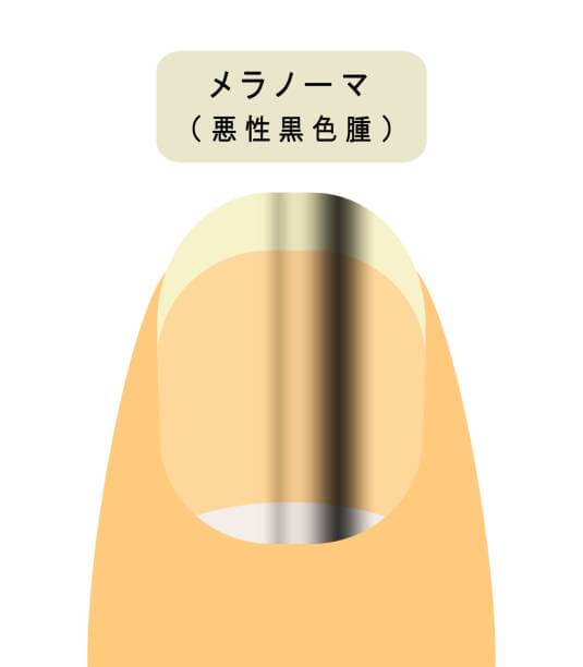 손톱 세로줄과 가로줄 원인이 당뇨와 암일까요? 손톱에 색깔이 변하거나 이상이 생기면 암을 생각할 수 있는데요~ 그 증상들과 관련이 있는지 참고하시기 바랍니다.