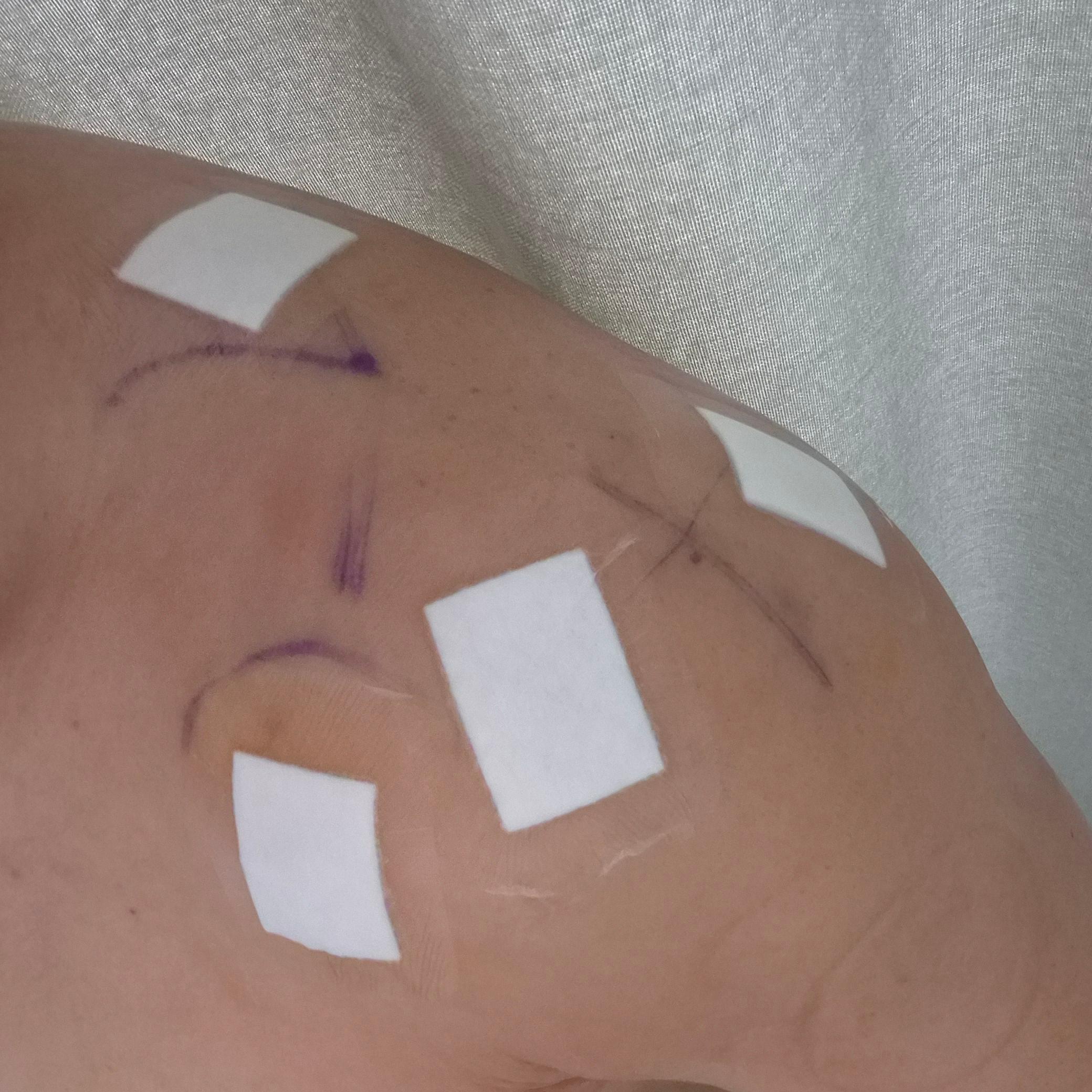 어깨 와순파열 봉합수술 후 mri사진 물리치료 기록