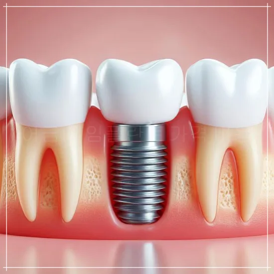 임플란트 모형