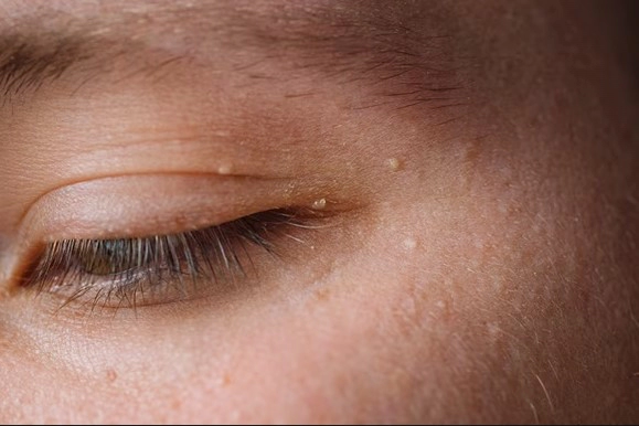 비립종 제거후 관리 방법 Tip