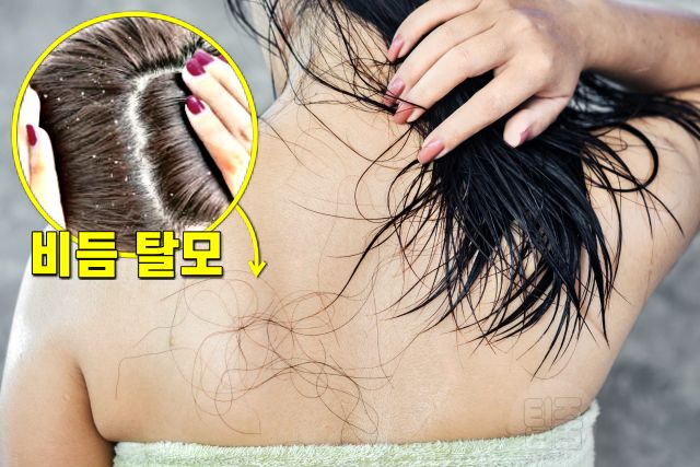 머리 안말리고 자면, 비듬 탈모, 두피관리, 팁줌