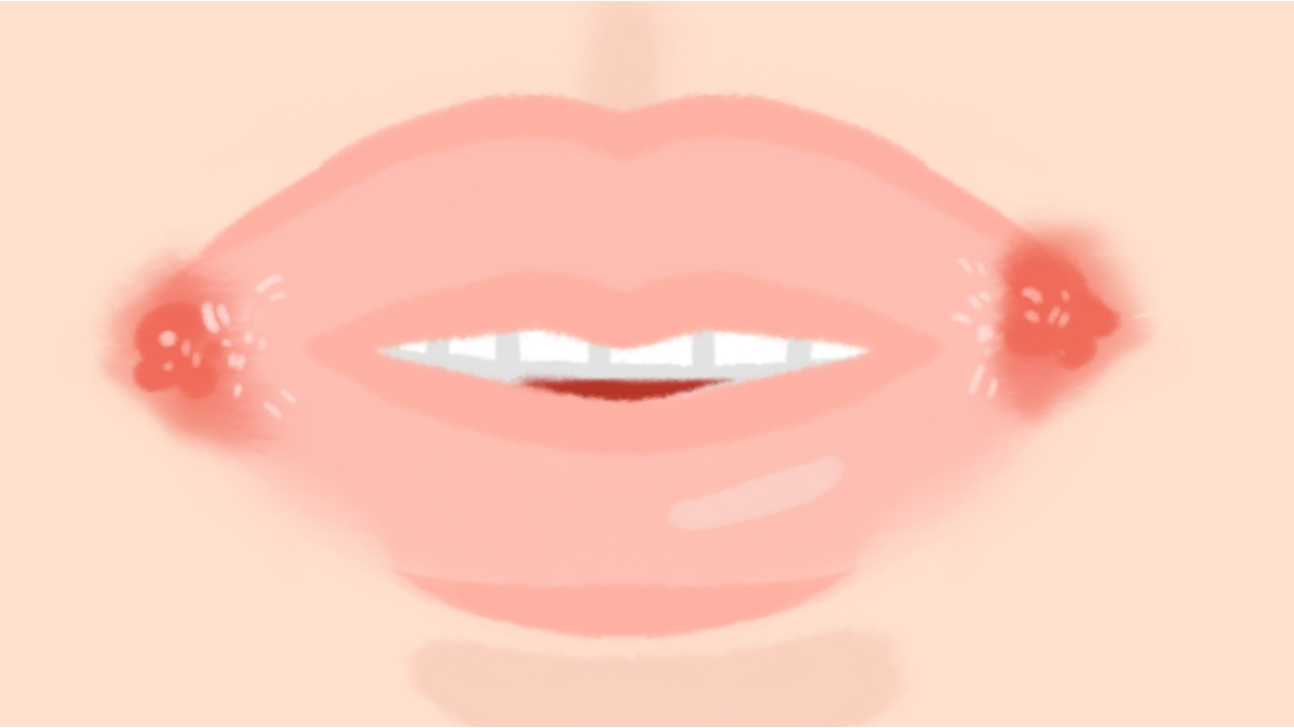 입술 헤르페스란?