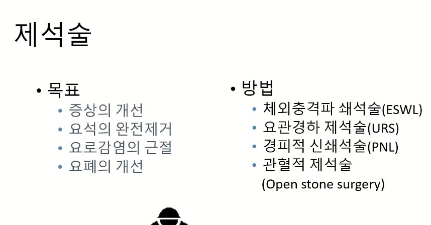 요로결석-제석술-구교철