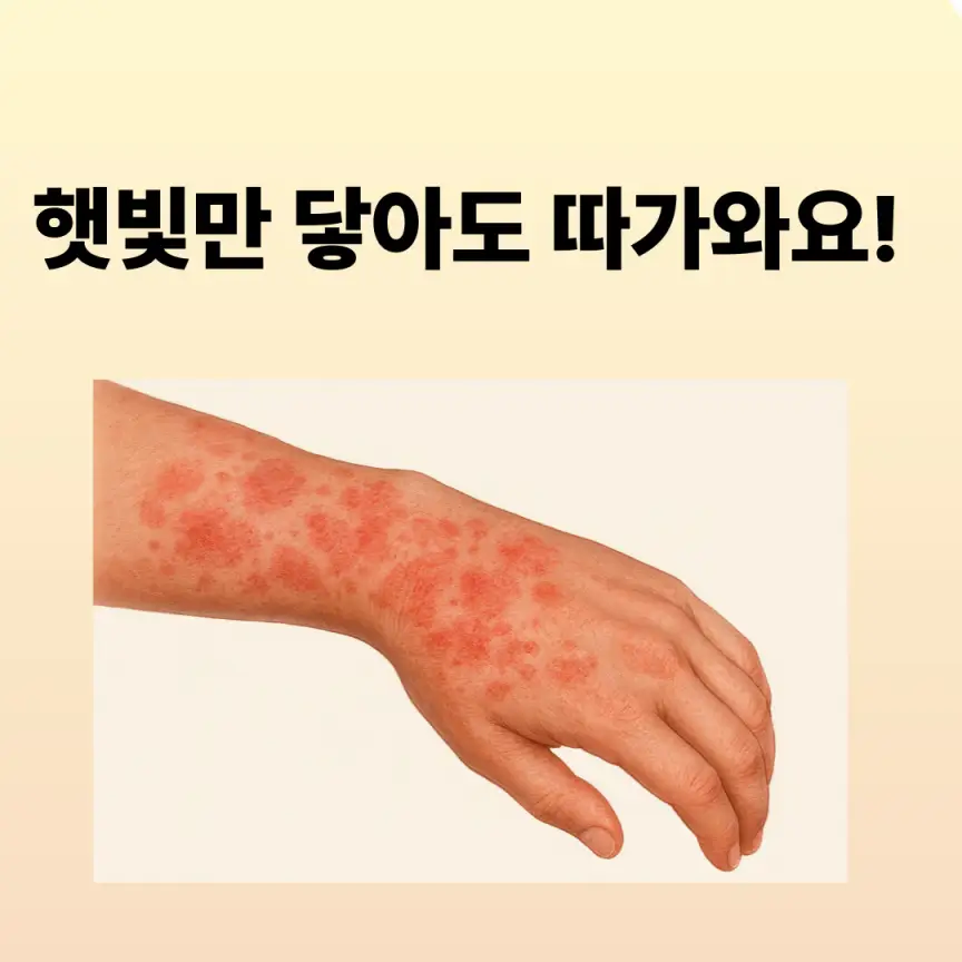 햇볕에 노출된 피부에 붉은 점이나 넓은 반점이 생겨요.