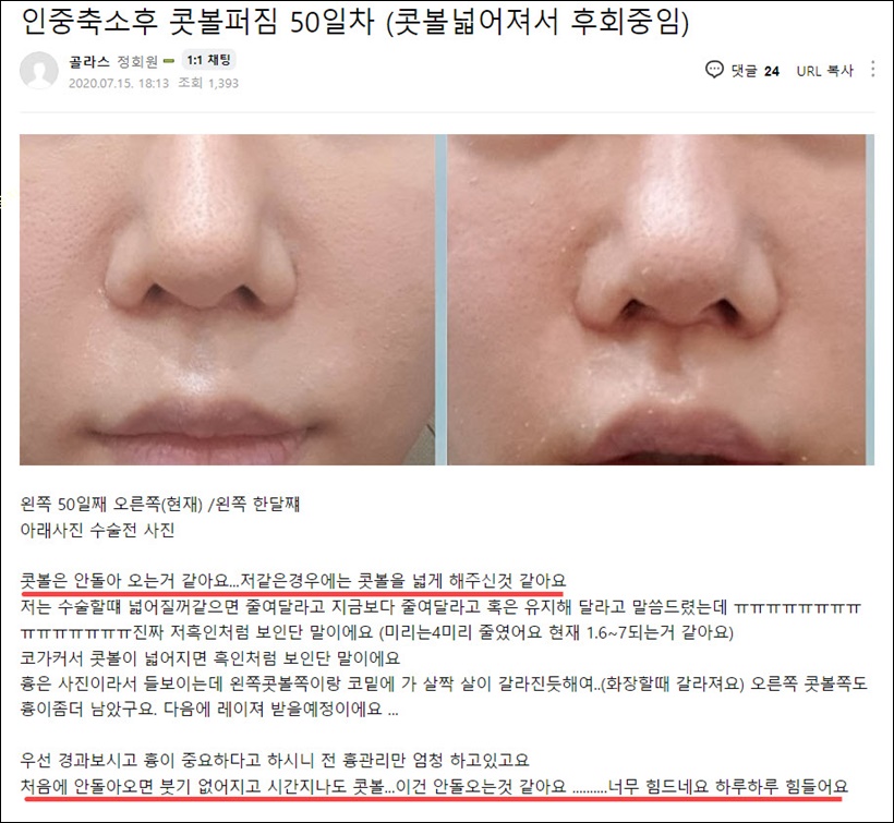 콧볼 수술 후기