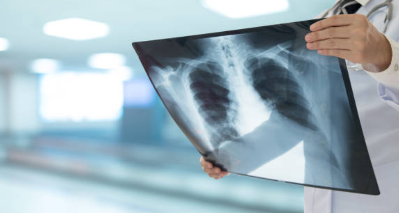 폐결핵과 관련된 사진