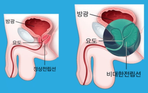 전립선비대증 요도
