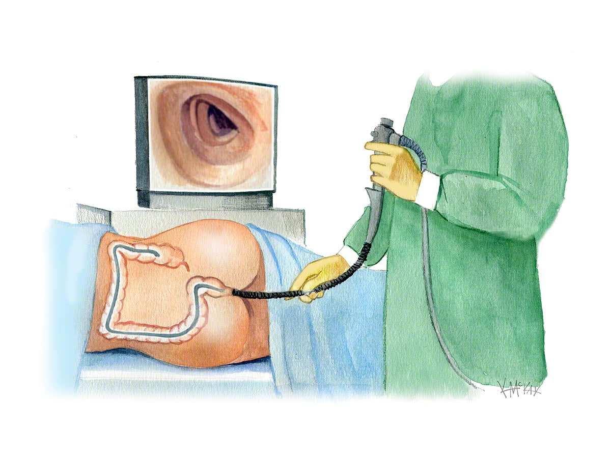 대장내시경