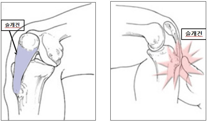 오스굿-슐라터 질환: 원인, 증상 및 치료법