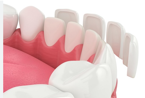 라미네이트 무엇 장점 단점