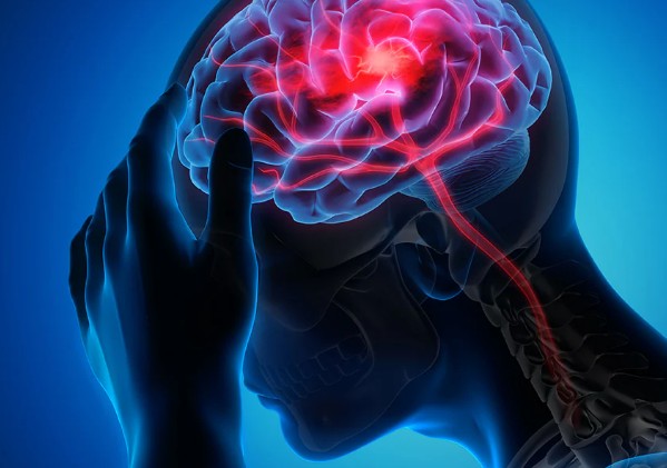 뇌졸중 원인과 증상, 골든타임과 예방법