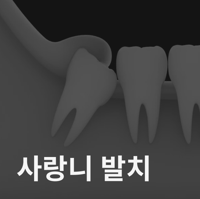 사랑니 발치