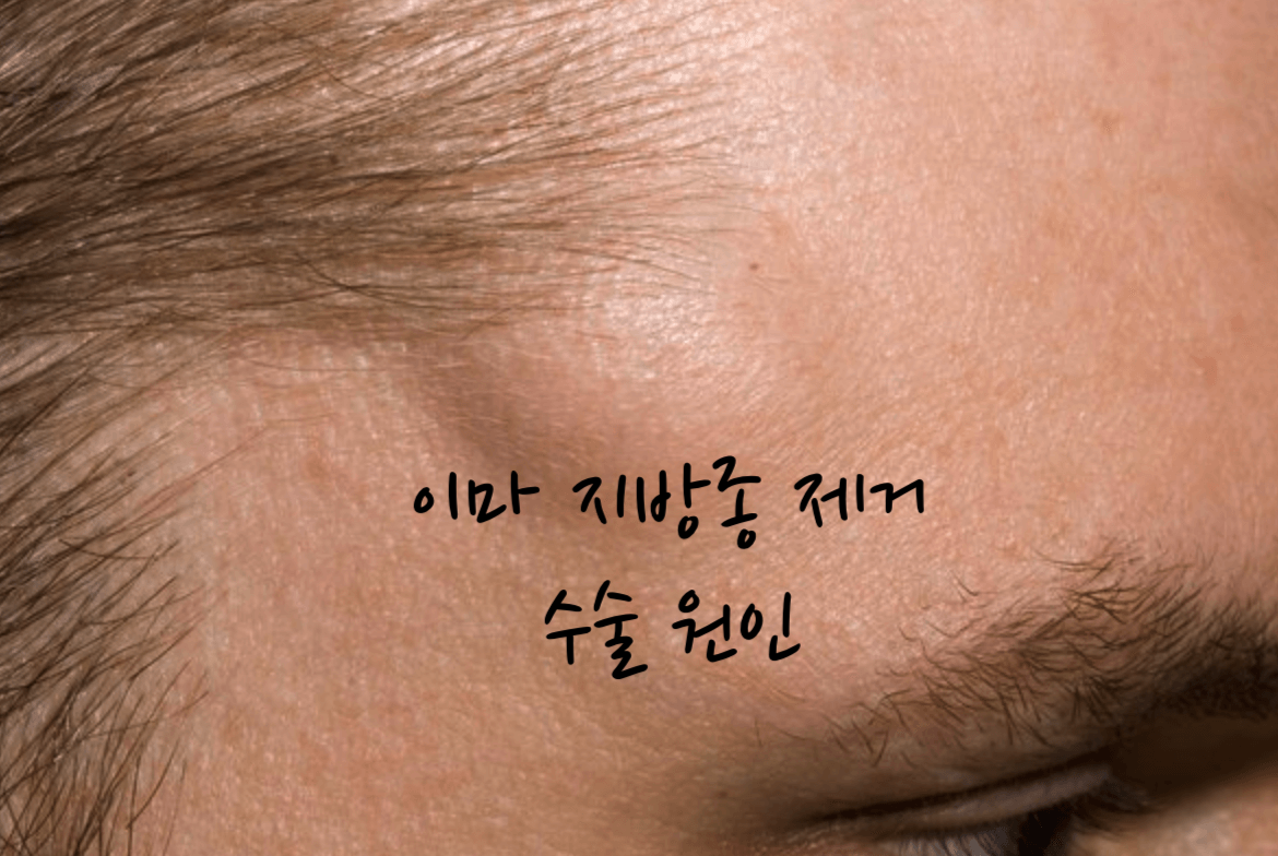 이마 지방종 제거