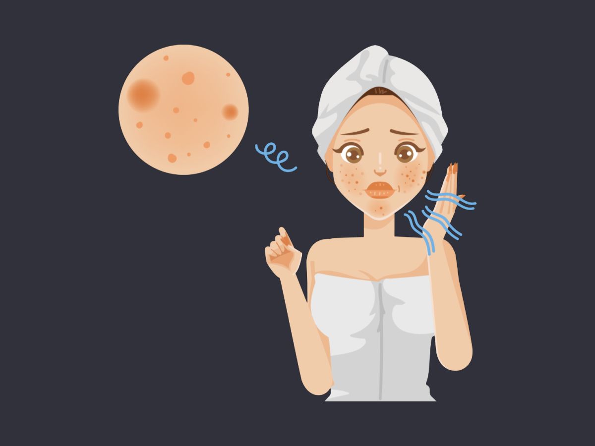 애크논 크림 부작용