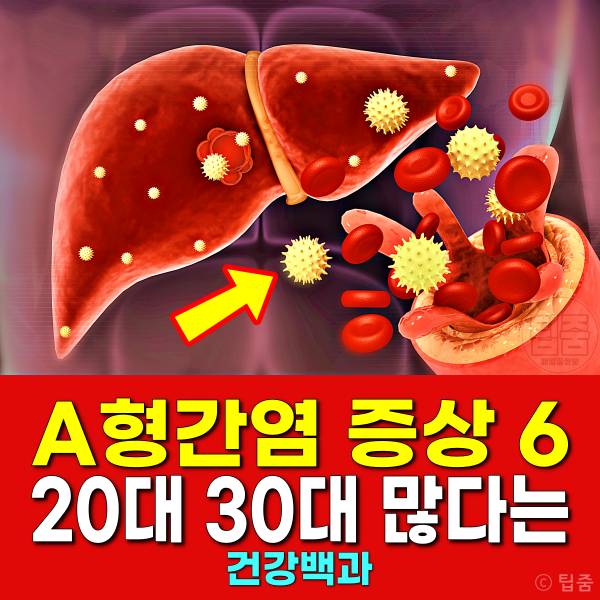 a형간염 증상 원인 20대 30대 많이 걸리는 병