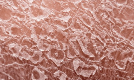 지루성피부염-원인과-치료방법