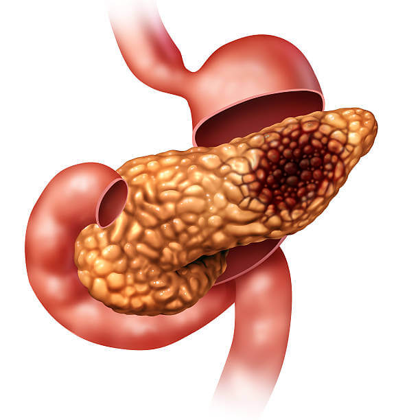 췌장암 신약 FDA 패스트 트랙 지정