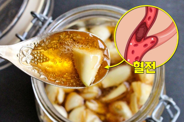 뇌혈관에 좋은 음식 꿀마늘 효능 혈전에 좋은 음식 마늘 꿀절임 효능, 건강 팁줌 매일꿀정보