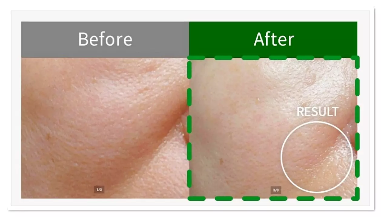 3주간 비쏠르 동안크림을 발랐을 때 잔주름과 굵은 주름의 감소를 확인하였습니다.