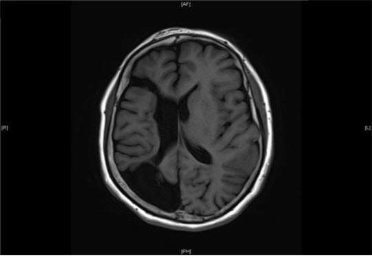 중풍의 전조증상