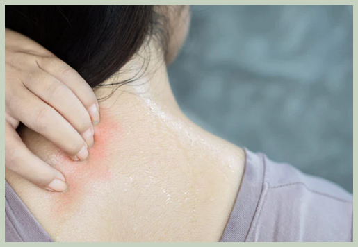 땀띠 증상 완화 및 가라앉히는 법