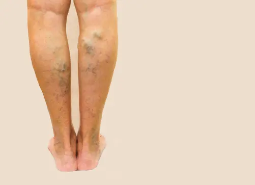 하지정맥류 초기 증상과 원인 치료방법