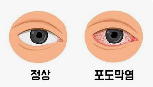 . 포도막염의 원인