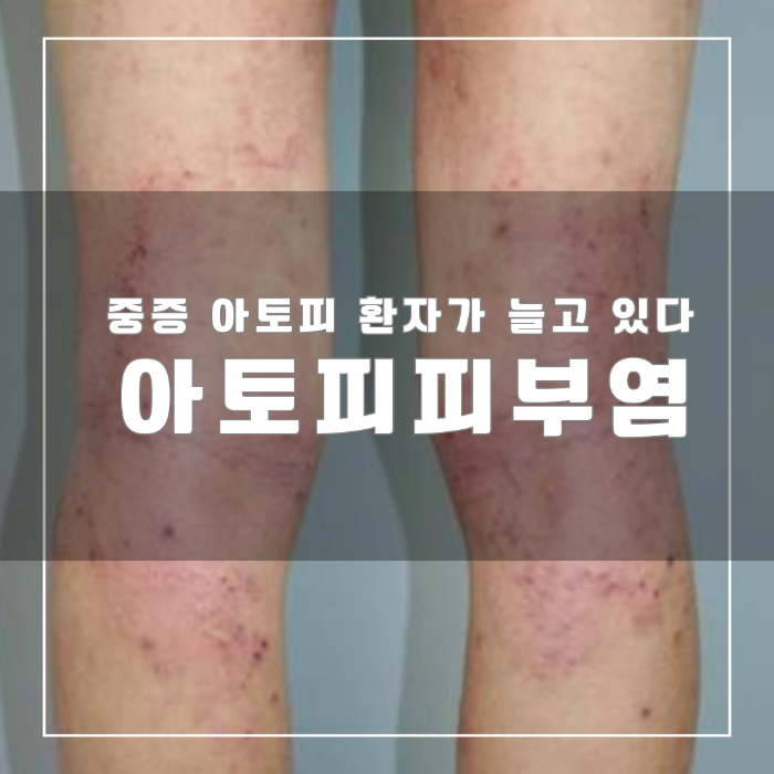 아토피 피부염