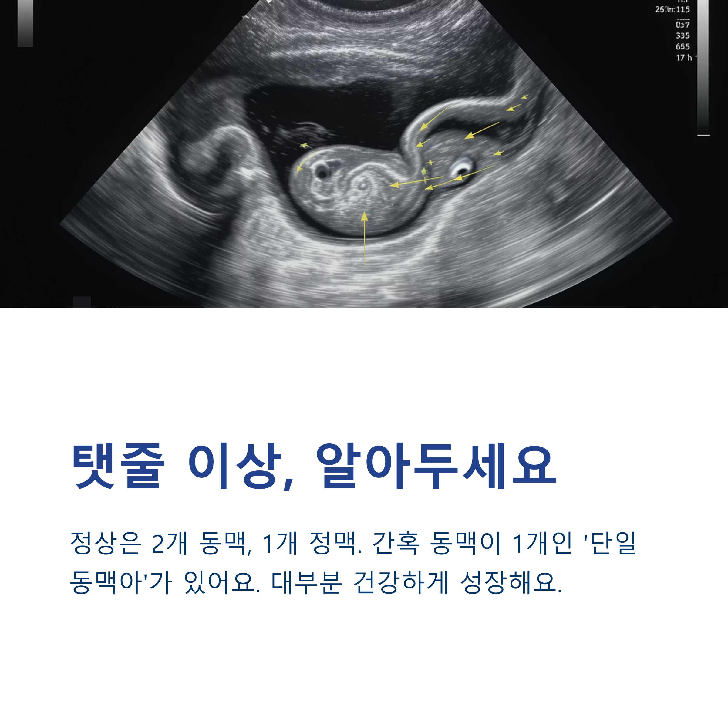 태아 초음파 이미지와 함께 탯줄 이상에 대한 설명이 포함된 인포그래픽. 정상 구조와 '단일 동맥 탯줄'에 대한 정보 포함