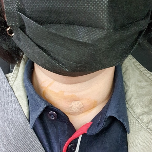 세침검사후