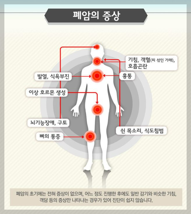 호흡기 질환:ㅡ폐암- 초기증상, 원인, 1기~말기까지 진행과정, 치료방법, 수술방법.