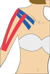 어깨 통증 (과도한 사용)